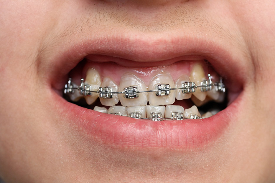 children teeth with braces
