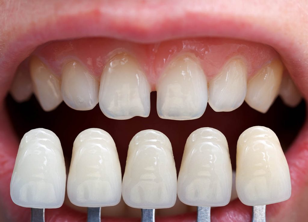 How Dental Veneers Can Improve Your Smile