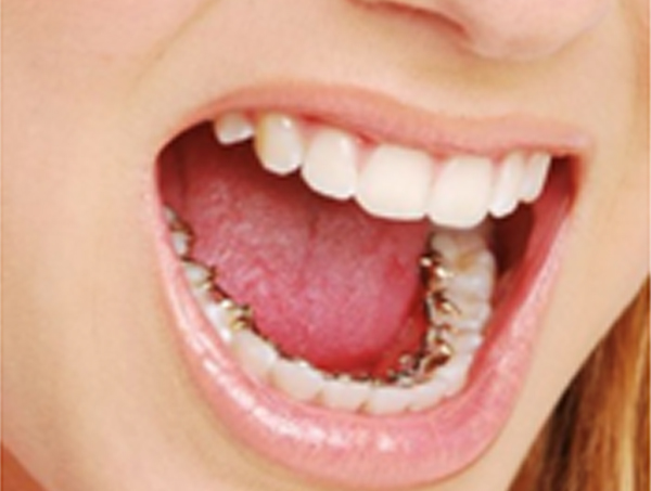 lingual braces procedure