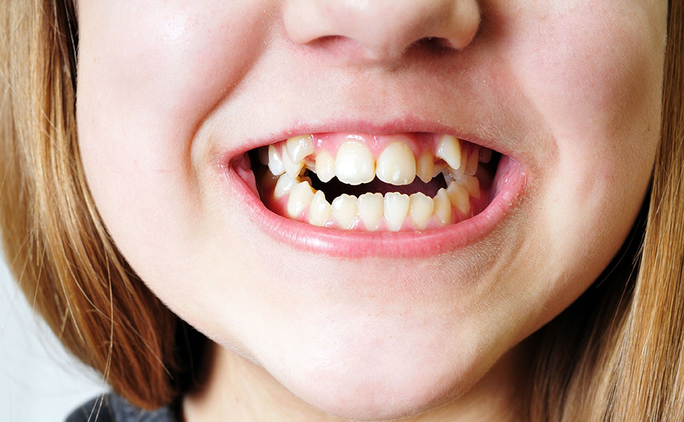 free dental braces for children