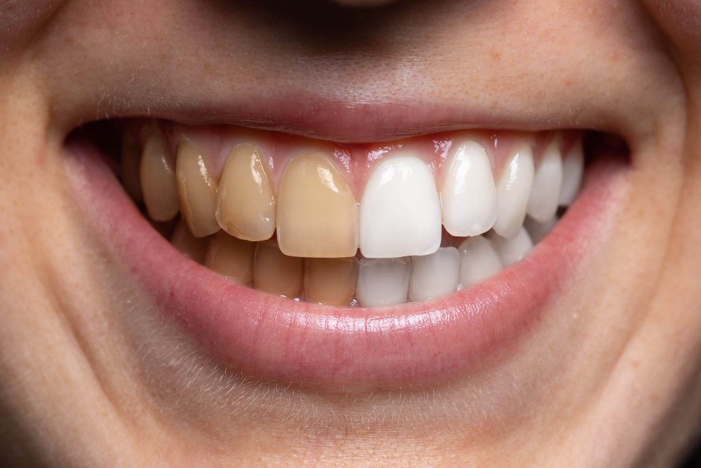 What Causes Teeth Staining?
