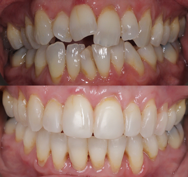 Invisalign Aligners