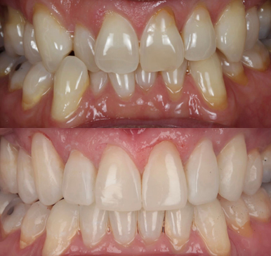 Invisalign Aligners
