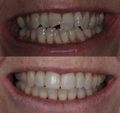 Invisalign Aligners