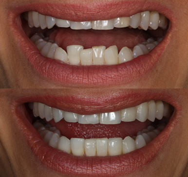 Invisalign Aligners