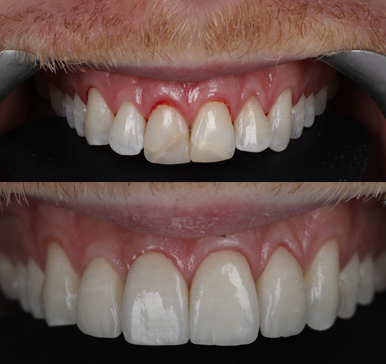 Porcelain Veneers