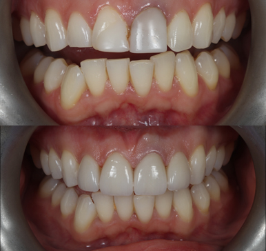 Porcelain Veneers