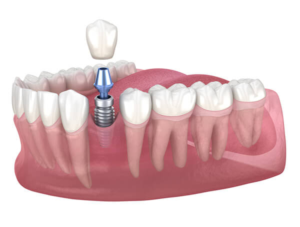 Benefits of Dental Implant Treatment