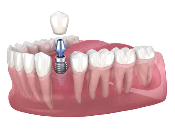 Benefits of Dental Implant Treatment