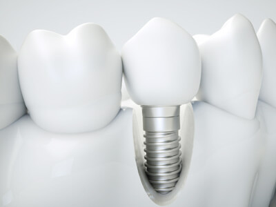 Implants & Oral Surgery