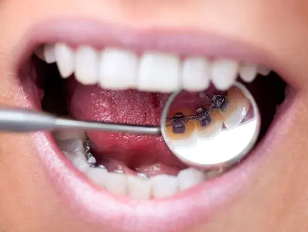 What are Lingual Braces?