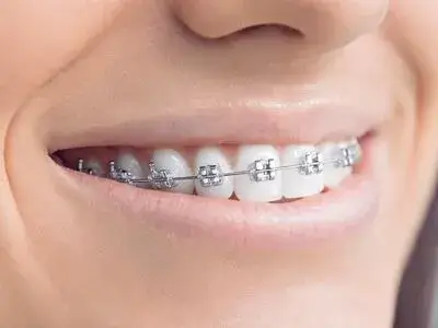 Metal Braces for Orthodontic Correction Wimbledon - A close-up image of a patient's smile showcasing metal braces used for orthodontic correction at Ridgway Dental, a dental clinic in Wimbledon. The braces are neatly affixed to the teeth, highlighting the clinic's precision in orthodontic treatments. The patient’s teeth appear well-aligned, indicating the effectiveness of the ongoing treatment. This scene emphasizes Ridgway Dental’s expertise in providing reliable and efficient metal braces to correct dental misalignments, ensuring improved oral health and a confident smile.