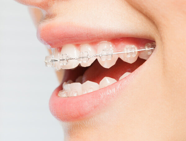 The Benefits of Ceramic Braces