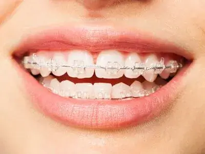 Orthodontic Braces for Improved Smile Wimbledon - A close-up image of a patient's smile, featuring ceramic braces used for orthodontic correction at Ridgway Dental, a dental clinic in Wimbledon. The braces are securely attached to the teeth, showcasing the clinic's expertise in providing discreet and effective orthodontic treatments. The patient's teeth are progressively aligning, indicating the success of the treatment. This scene highlights Ridgway Dental's commitment to enhancing smiles through advanced orthodontic solutions, ensuring both aesthetic appeal and improved oral health.