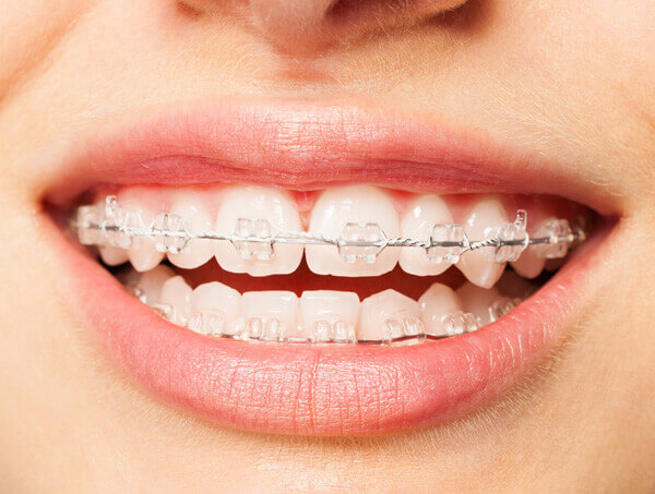 What are Ceramic Braces?